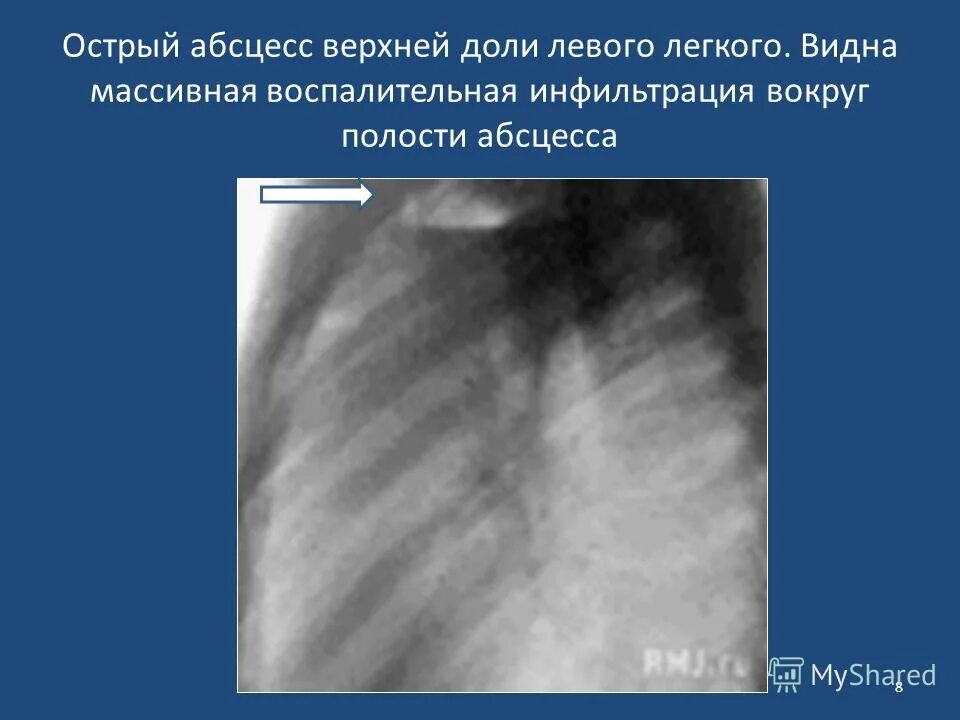 Абсцесс легкого рентген. Абсцесс нижней доли левого легкого. Образование верхней доли левого легкого