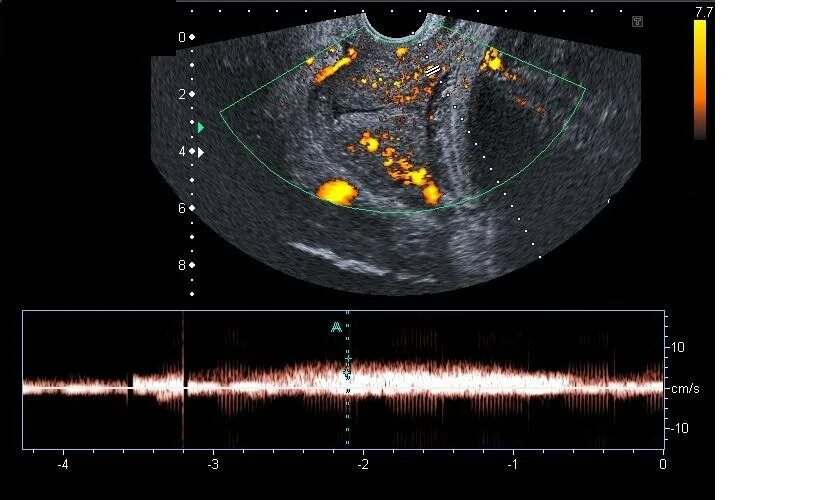 Повышен маточный кровоток. Кровоток в матке. усиленный кровоток в матке. препараты для улучшения кровотока в матке. усиленный кровоток в матке при беременности.