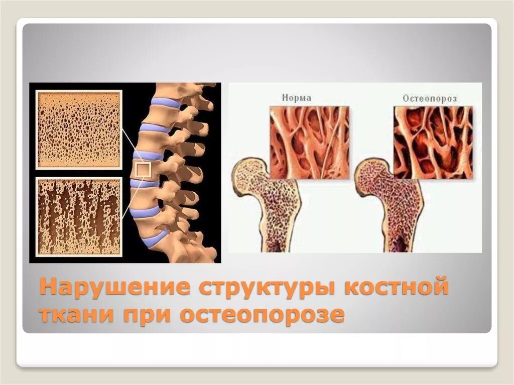 Остеопороз википедия. Профилактика остеопороза. Остеопороз на кт. Остеопороз в самаре. Профилактика остеопороза.