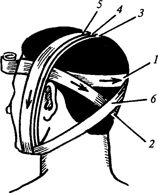 Повязка уздечка техника наложения. Перевязка уздечка головы. Десмургия повязка уздечка. Технику наложения повязки «уздечка».. Повязка уздечка накладывается