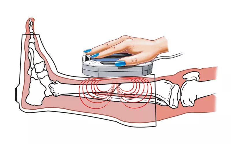Реабилитация после травмы. Магнитотерапия для коленного сустава. Электростимуляция мышц нижних конечностей. Физиотерапия реабилитация. Массаж при переломе ноги.