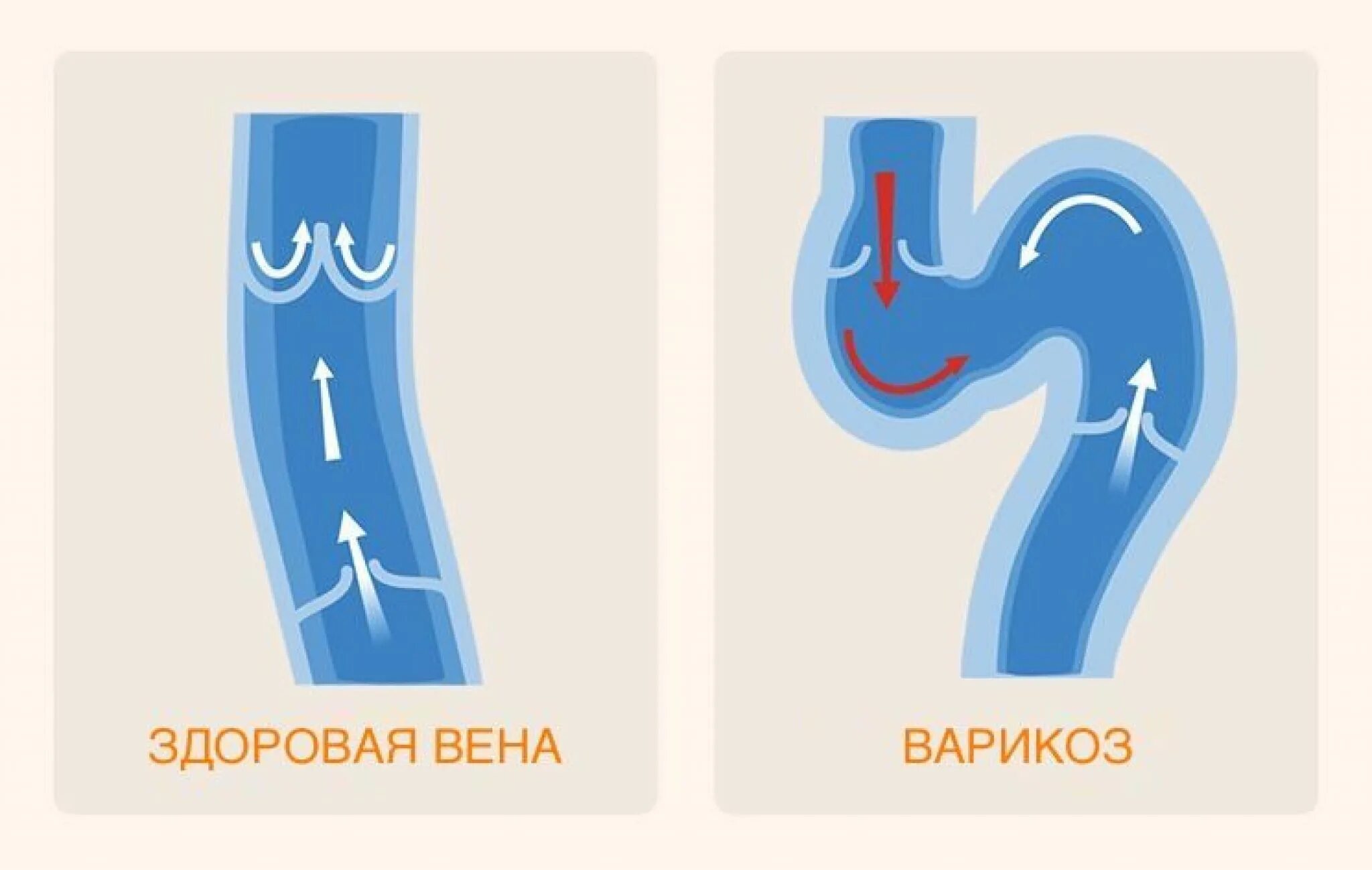 Варикозные вены пищевода мкб 10. ВРВП -варикозное расширение вен пищевода. Варикозно расширенные вены желудка. Варикозно расширенные вены пищевода. Варикоз вен желудка рисунки.