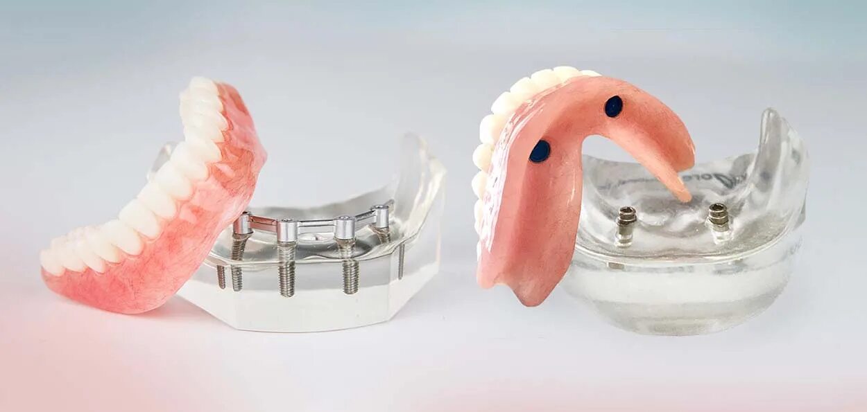 Снимать ли зубные протезы на ночь. Покрывные протезы ортопедическая стоматология. Перекрывающие съемные протезы.