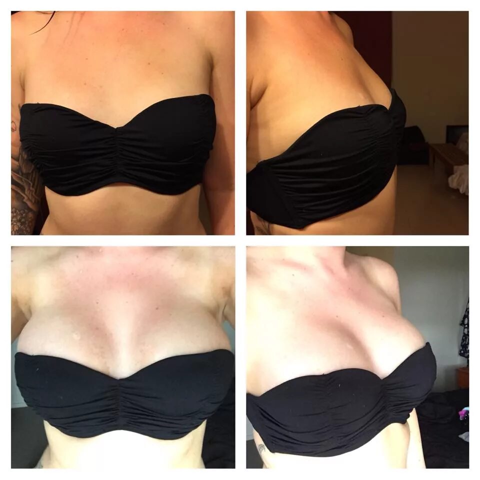 Девушка увеличила грудь. Mentor круглый высокий профиль 325 мл. Каплевидная форма груди. Грудь до и после приема кок. Анатомические импланты ментор 225 мл.