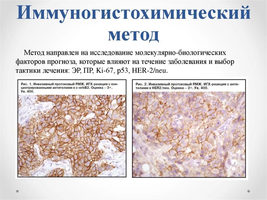 Иммуногистохимия при онкологии молочной железы. Иммуногистохимические методы исследования в гистологии. Иммуногистохимия принцип метода. Иммуногистохимические исследования в онкологии.