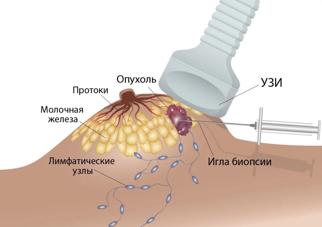 Аспирационная биопсия молочной железы. Вакуум аспирационная биопсия молочной железы. Тонкоигольная аспирационная биопсия. Трепан биопсия молочных желез.