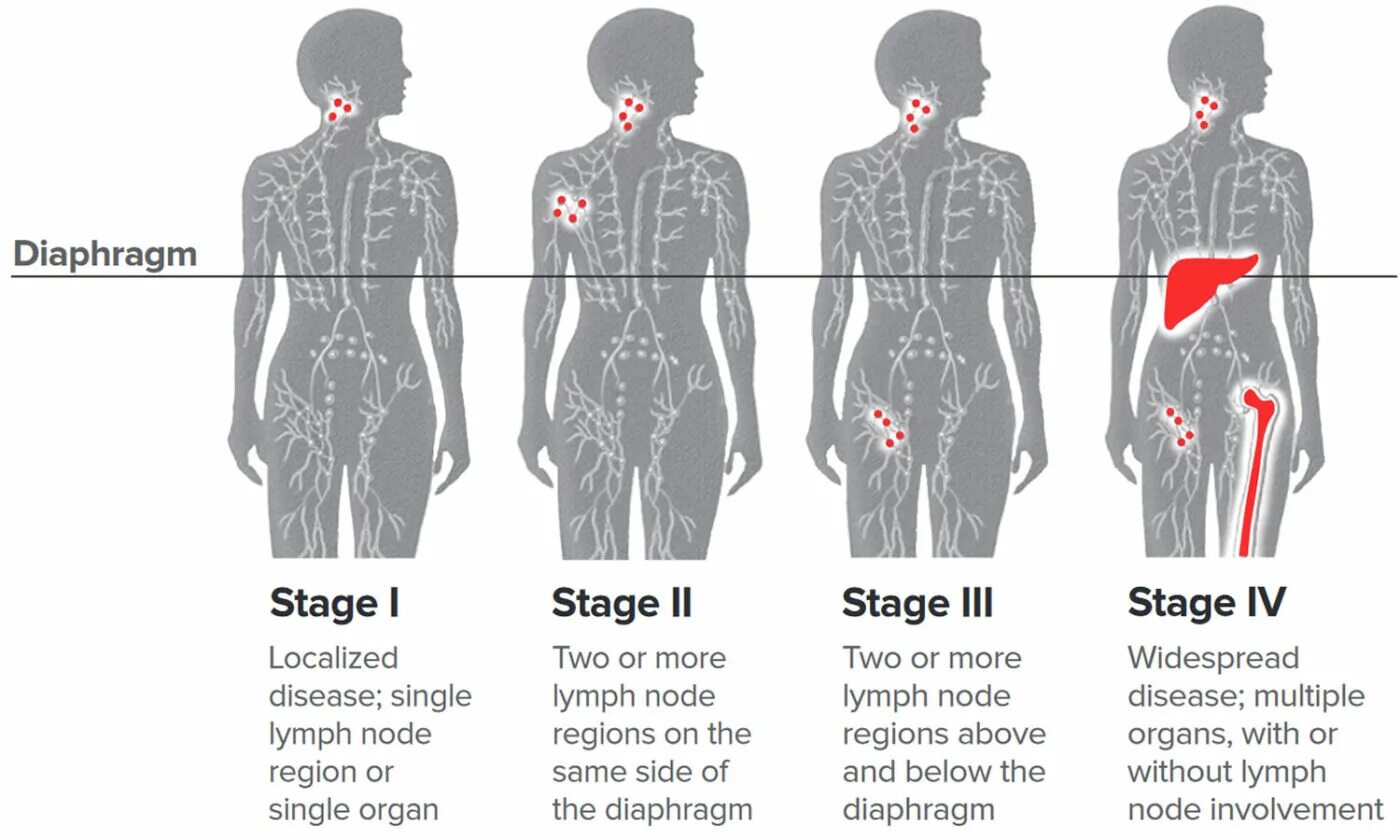 Болезненный безболезненный. Стадии заболевания лимфома Ходжкина. Лимфома Ходжкина поражение лимфоузлов. Стадия заболевания лимфомы Ходжкина. Лимфома Ходжкина лимфоузлы поражение.