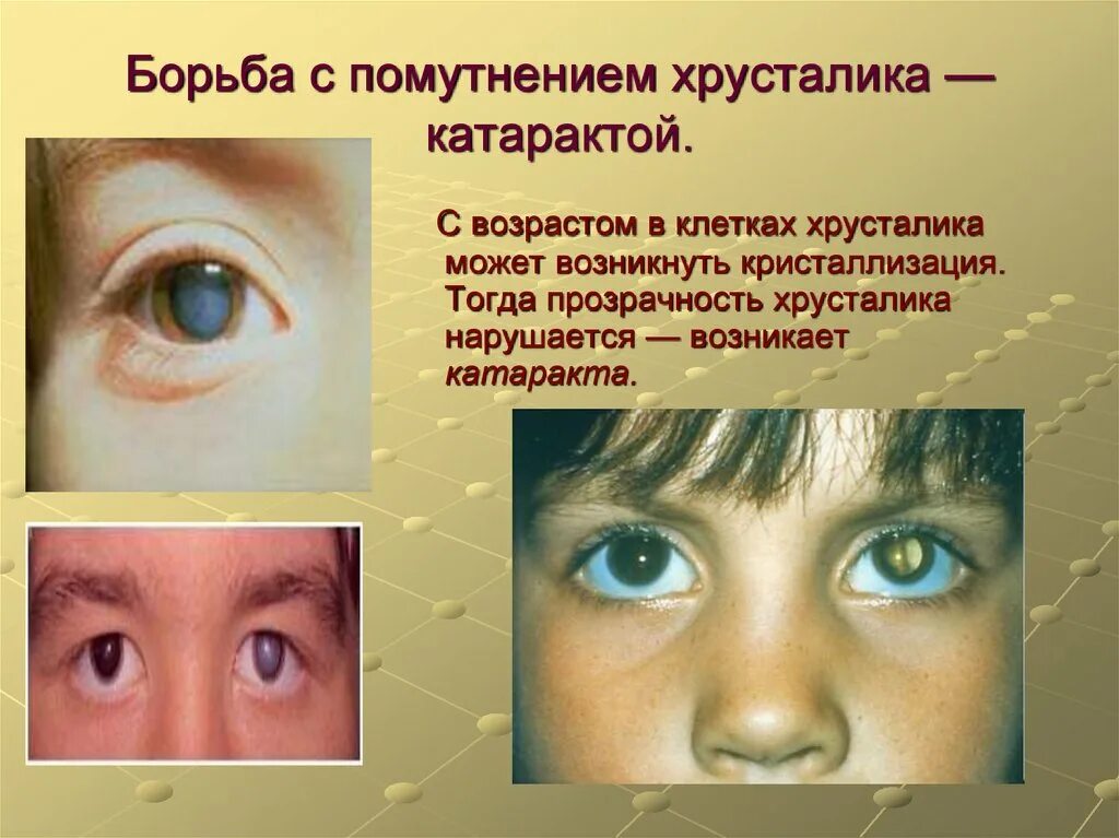 Гигиена зрения предупреждение глазных болезней 8 класс. Борьба с помутнением хрусталика. Катаракта помутнение хрусталика. Профилактика катаракты глаза.
