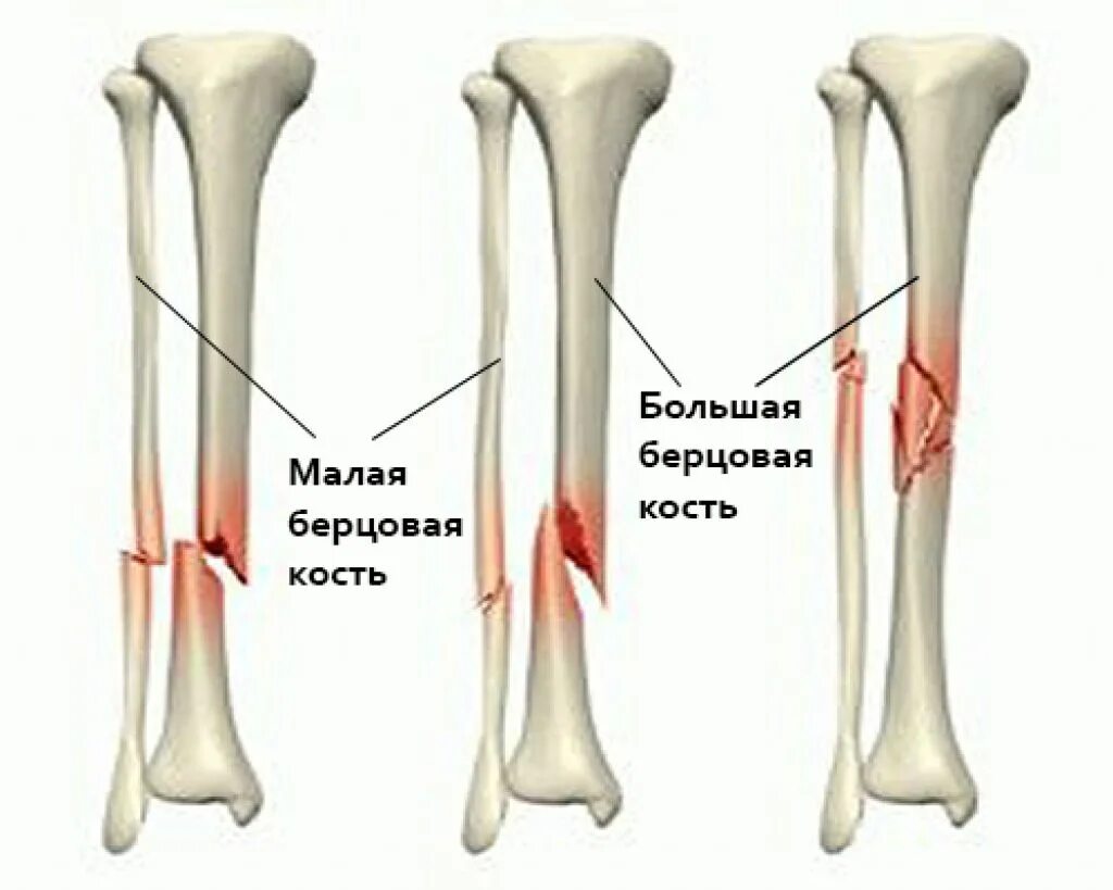 Сломал малую берцовую