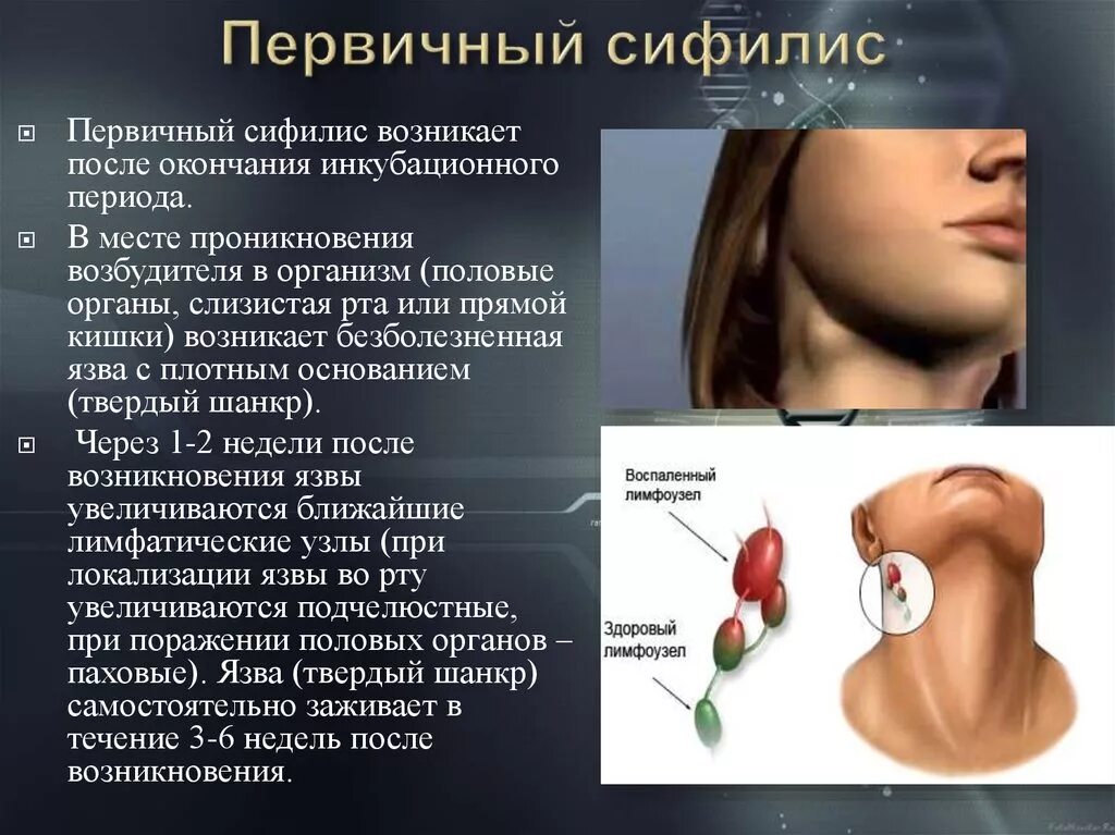 Глоток обнаружить. Первичные проявления сифилиса. Симптомы первичного сифилиса. Первичный сифилис проявляется. Первые симптомы сифилиса.