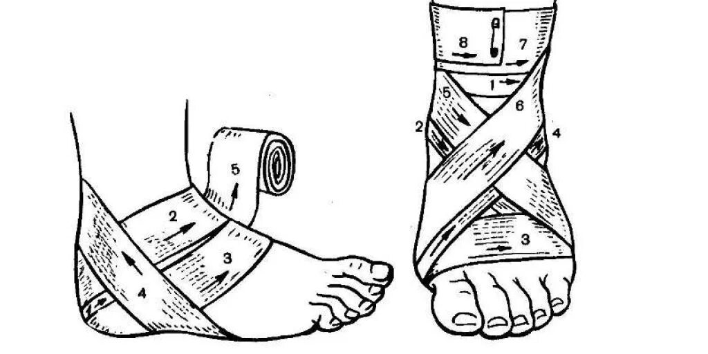 Перевязка голеностопа бинтом. Бинтование эластичным бинтом голеностопного сустава. Наложите эластический бинт на нижнюю конечность. Бинтование эластичным бинтом нижней конечности. Бинтование ноги после операции