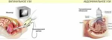 Трансвагинальное узи можно ли девственницам. Трансвагинальное узи можно ли девственницам