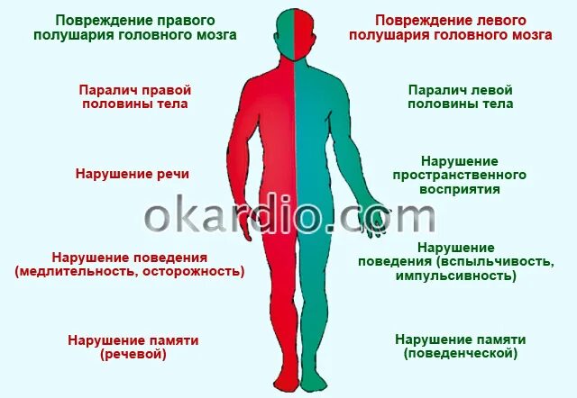 Левое полушарие мозга инсульт. Симптомы при поражении левого полушария. Парализовало левую сторону. Паралич половины тела. Ишемический инсульт последствия.