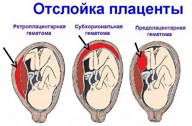 Отслойка хориона на ранних сроках. Ретроплацентарная отслойка плаценты. Гематома при беременности во 2 триместре беременности. Отслойка нормально расположенной плаценты симптомы. Отслойка с гематомой при беременности.