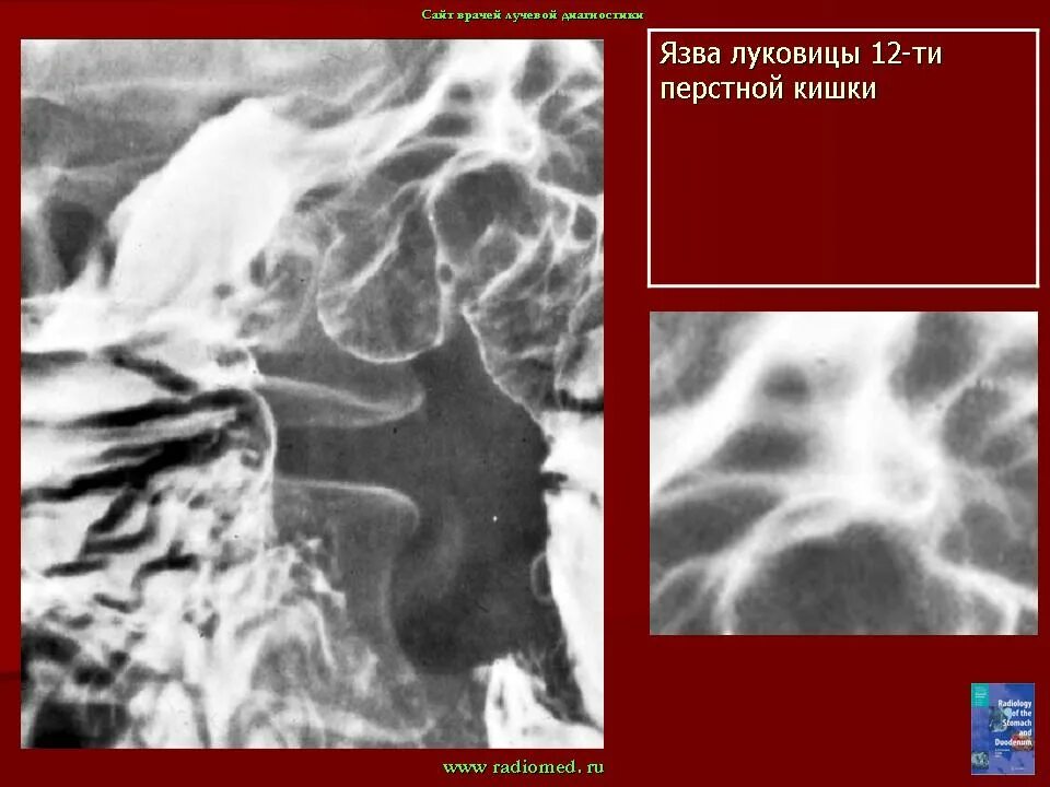 Радиомед портал радиологов. Язва 12 ти