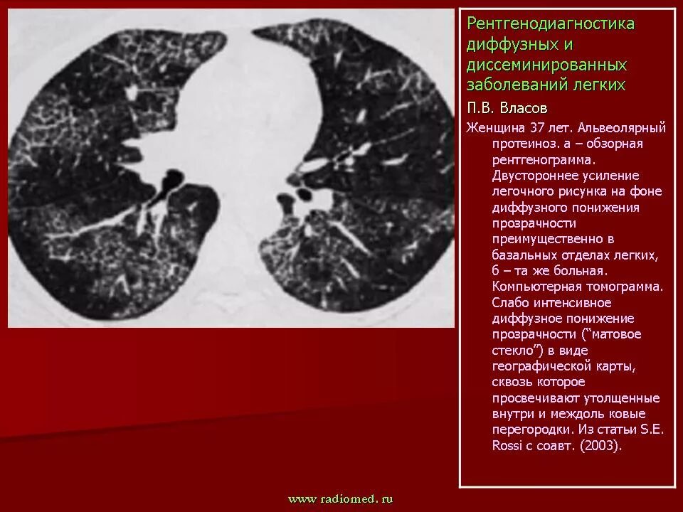 Альвеолярный протеиноз легких на кт. Легочный альвеолярный протеиноз кт. Легочный альвеолярный протеиноз рентген. Альвеолярный протеиноз легких рентген. Диффузные изменения в легких