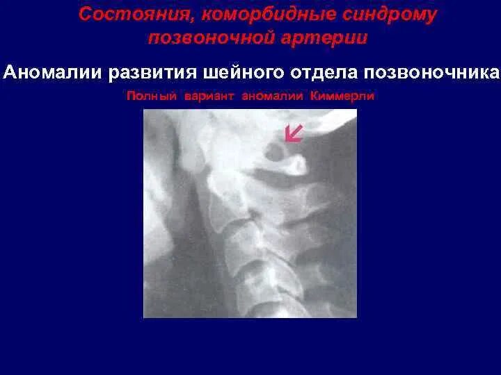 Аномалии развития шейного отдела позвоночника рентген. Аномалии Киммерли шейного отдела. Аномалия Киммерли с1 позвонка что это такое. Аномалия развития шейных позвонков на рентгене.