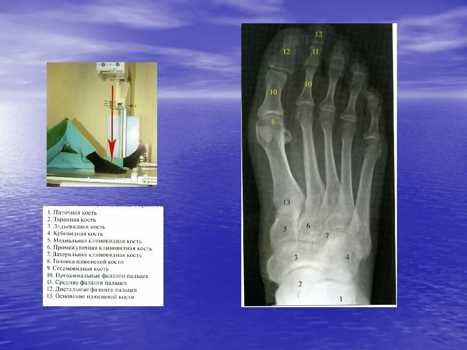 Таранная кость голеностопного сустава. Рентген большеберцовой кости норма. Рентген анатомия кости. Рентген анатомия кости. Лучевая кость и локтевая кость анатомия.