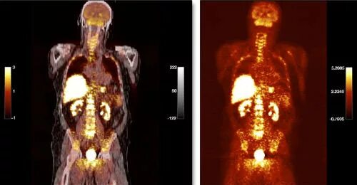 Позитронно-эмиссионная томография (ПЭТ). ПЭТ-кт опухоль позвоночника. ПЭТ кт здорового человека снимки. Снимок ПЭТ кт здорового человека. Что можно перед пэт кт с контрастом