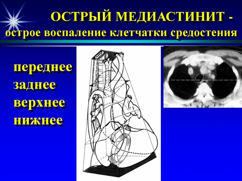 Фиброзирующий медиастинит. Медиастинит этиопатогенез. Острый Гнойный медиастинит. Гнойный медиастинит