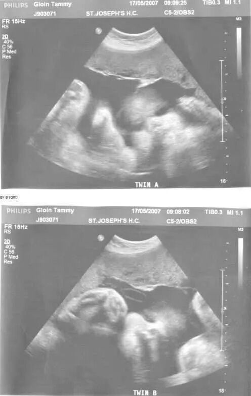 УЗИ двойни на 32 неделе беременности. УЗИ двойни на 20 неделе беременности. УЗИ 22 недели беременности двойня. УЗИ ребёнка на 20 недели беременности двойни. 18 неделя близнецов