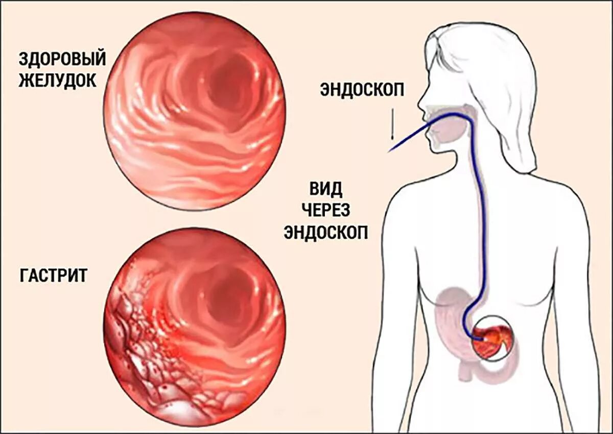 Dfjcnhbn. Хронический гастрит изжога