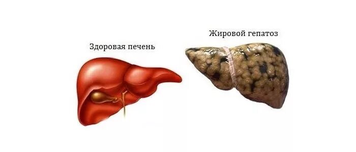 Гепатоз ожирение печени. Алкогольный жировой гепатоз печени. Гепатоз печени висцеральный жир. Печень гепатоз жировой гепатоз.