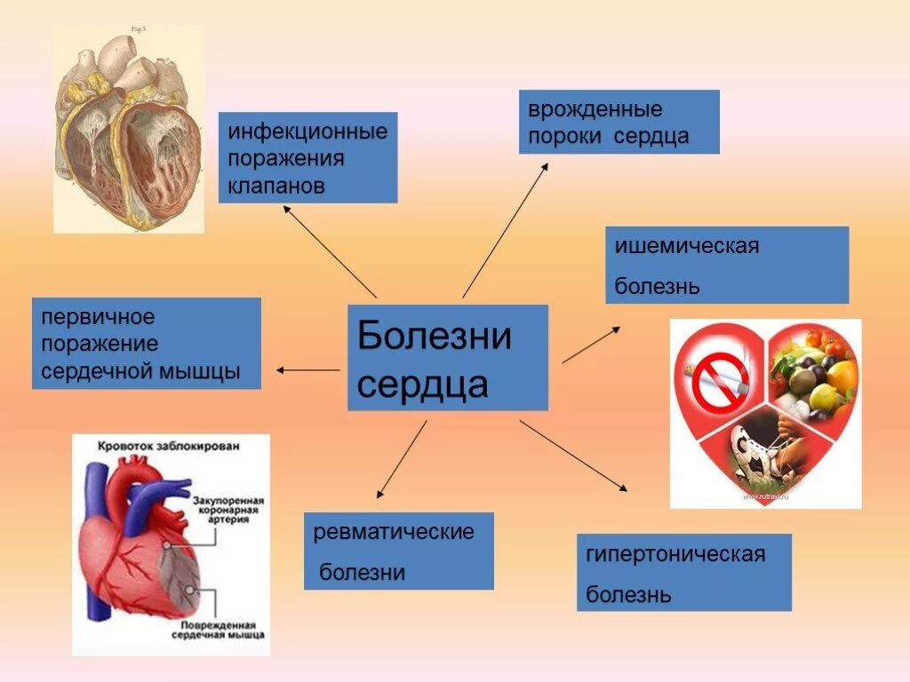 Болезни сердца у людей