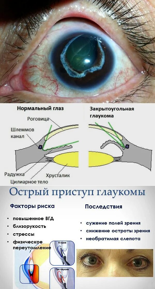 Может ли внутриглазное давление. Закрытоугольная глаукома профилактика. Острый пристуап локуума. Отстрвй присьуп гдаукоиаю. Глаукома, повышенное внутриглазное давление.