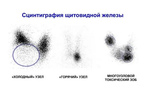 Стенография щитовидной железы