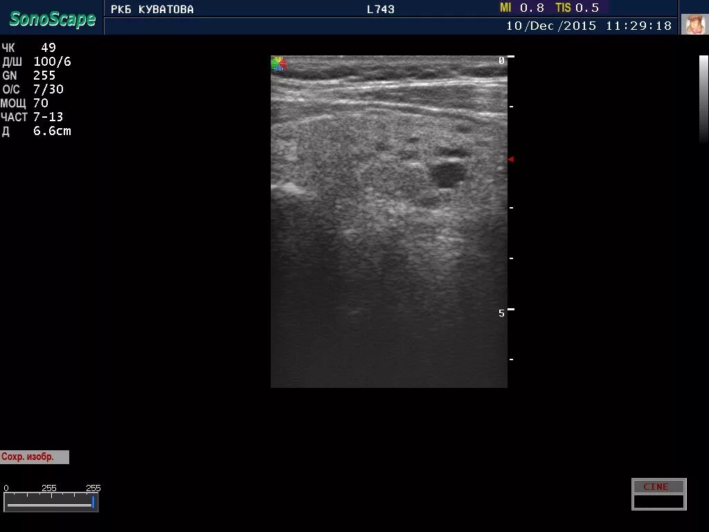 Узел щитовидной железы 33.7. Узел щитовидной железы подкапсульный. Щитовидная железа узелок на УЗИ. Кровоток в щитовидной железе по УЗИ. Перинодулярный кровоток что это