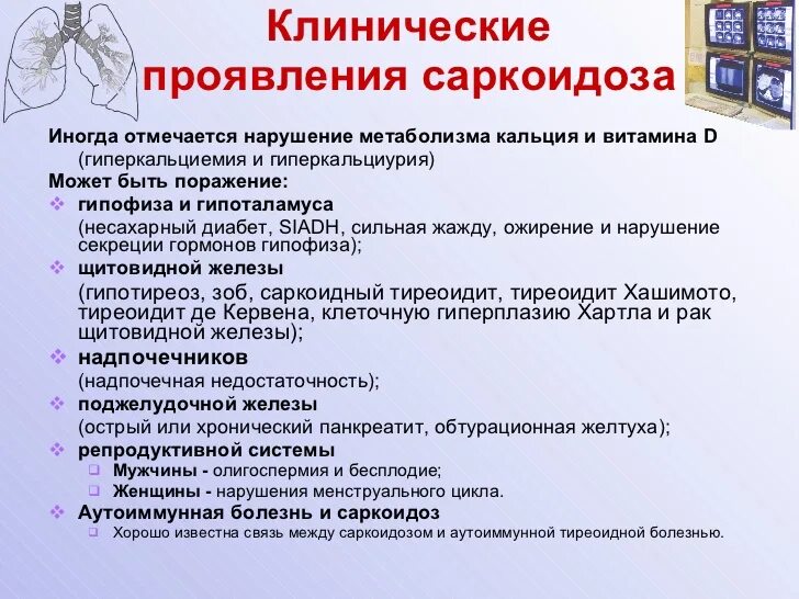 Узловатая эритема при саркоидозе. Саркоидоз легких кт заключение. Саркоидоз легких классификация. Саркоидоз легких по мкб 10. Классификация хоменко саркоидоза.
