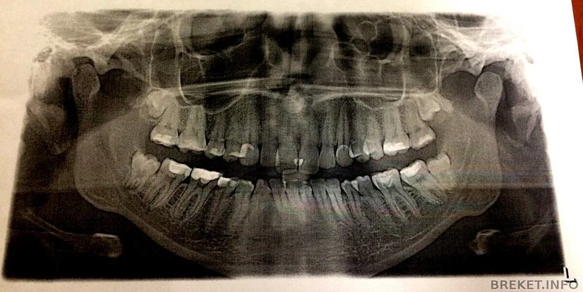 Снимок зубов видное. Ретинированный дистопированный зуб.