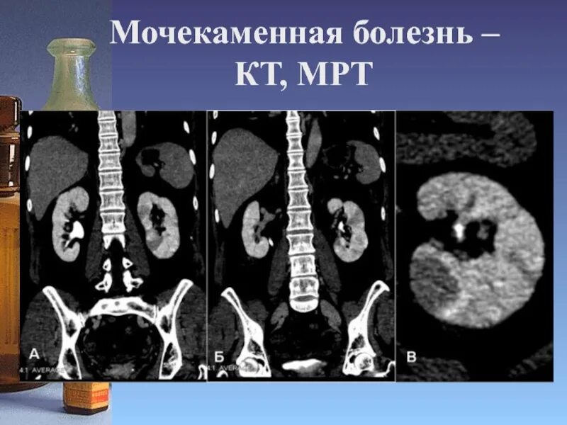 Пиелонефрит кт
