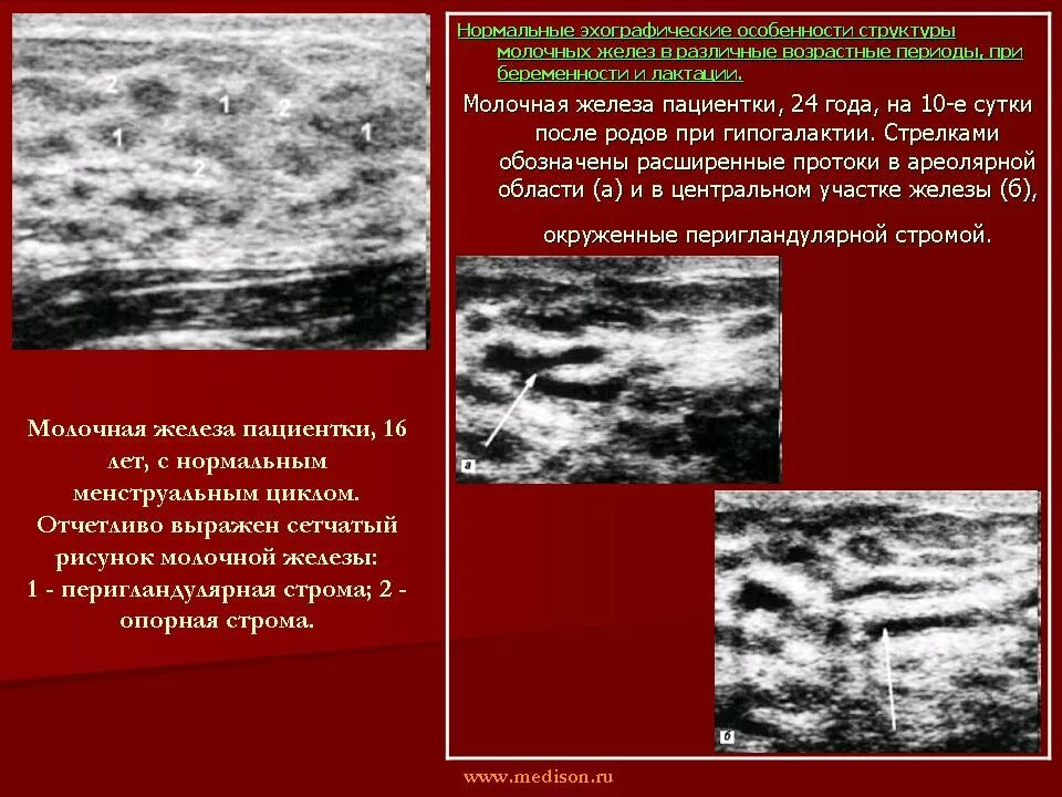 Узи молочных киров. Узи молочной железы. узи молочных желез методика проведения. памятка узи молочных желез. узи картина молочной железы.