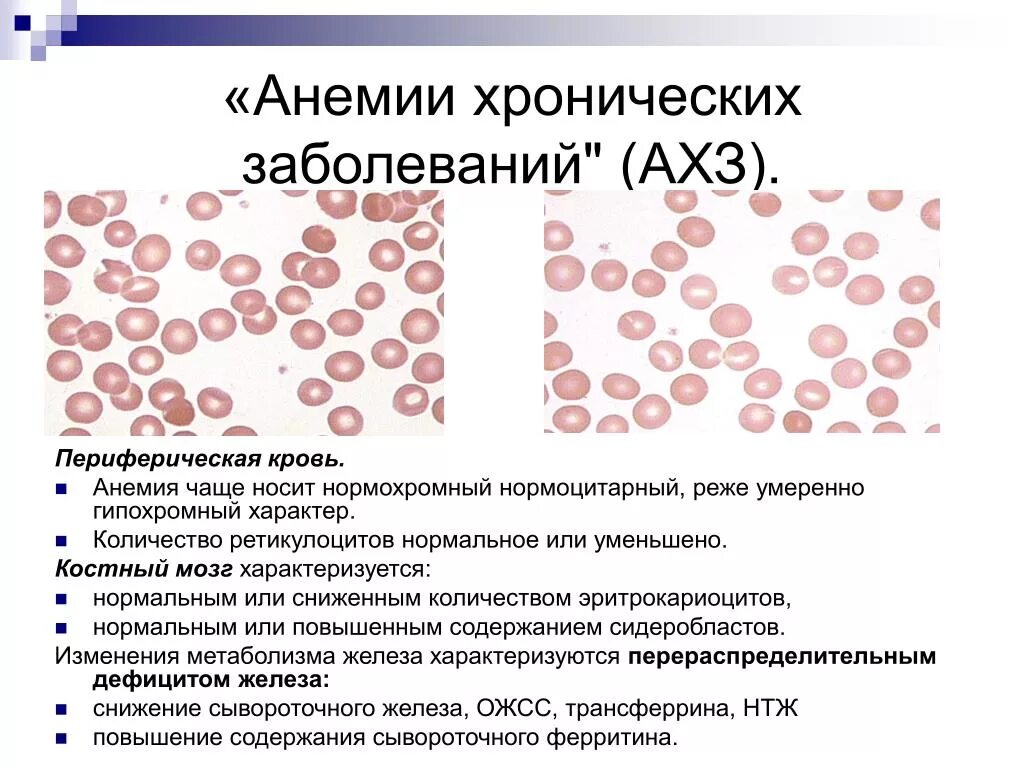 Показатели крови при анемии хронических заболеваний. Анемия хрон заболеваний. Анемия хронических заболеваний картина крови. Анемия хронических заболеваний характеристика.