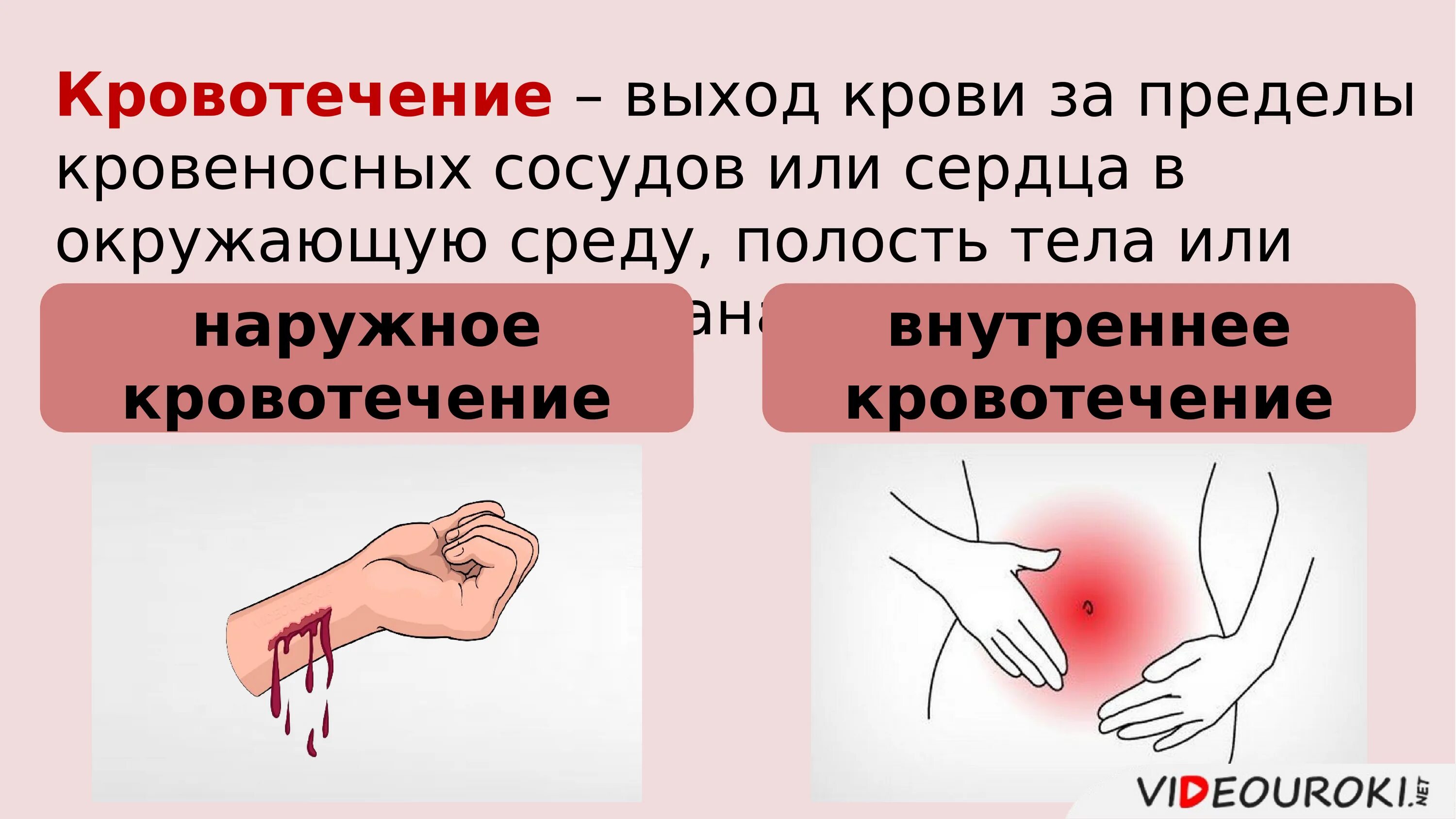 Какое кровотечение наблюдается. Наружное и внутреннее кровотечение. Наружные и внутренние кровотечения. Внутреннее и внешнее кровотечение. Кровотечения кровотечению.