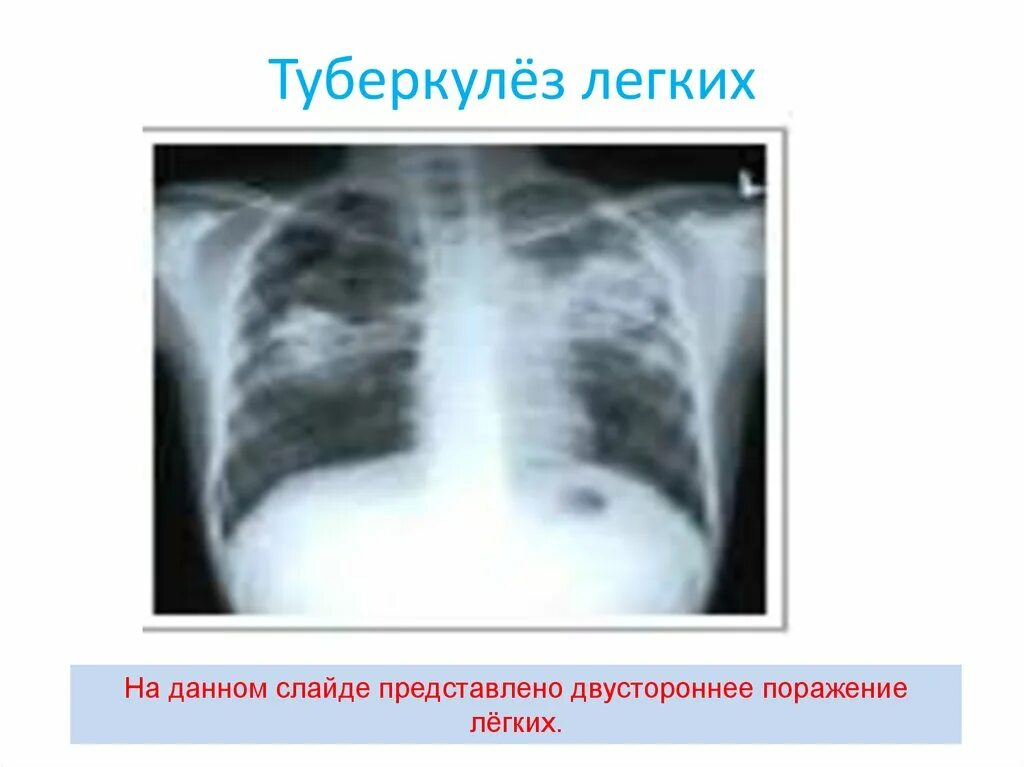 3 поражения легких. Туберкулез поражение легких. Поражение лёгких туберкулёзом. Двустороннее поражение лёгких.