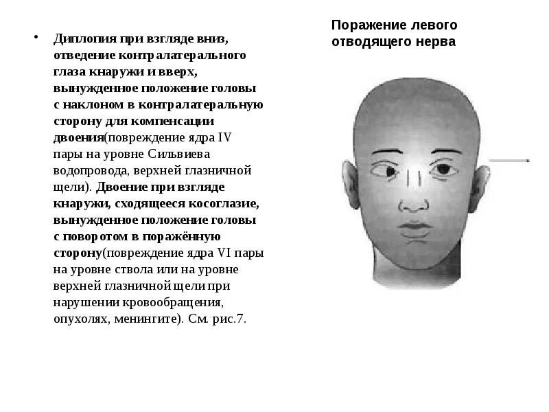 Двоение в одном глазу. Диплопия. Диплопия при взгляде вниз. Нарушение зрения диплопия. Lbgkgbz.