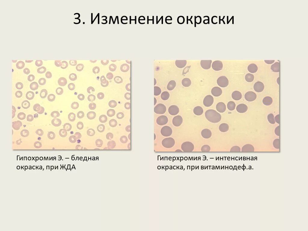 Гипохромия железодефицитная анемия. Гипохромия и гиперхромия. Нормохромия гипохромия. Гиперхромия эритроцитов в крови. Гиперхромная анемия эритроциты.