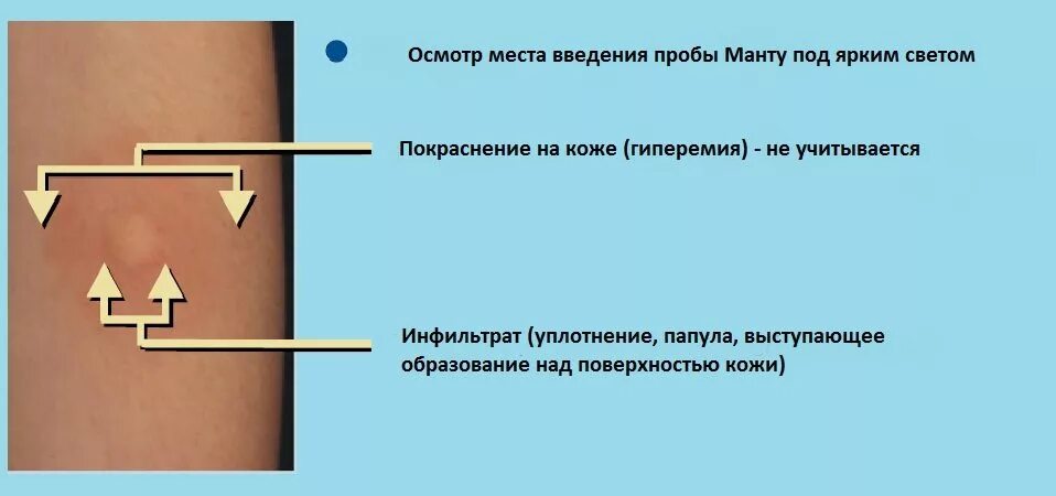 Диаскинтест норма реакции у детей 7 лет. Реакция на туберкулез диаскинтест. Диаскинтест Размеры норма. Проба диаскинтест оценка результата у детей. Какой результат диаскинтеста