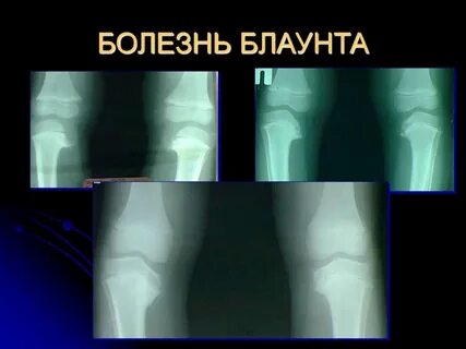 Синдром бланда уайта