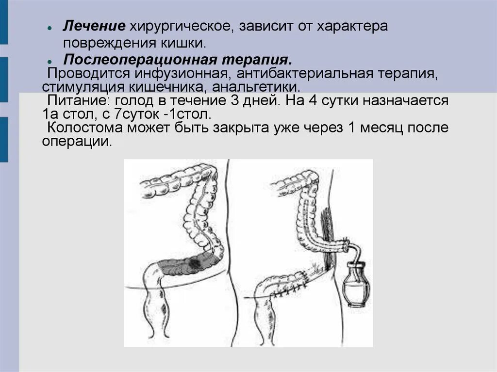 Повреждение толстой кишки. Повреждения прямой кишки при травмах. Схема операций на толстом кишечнике. Разрыв Толстого кишечника.