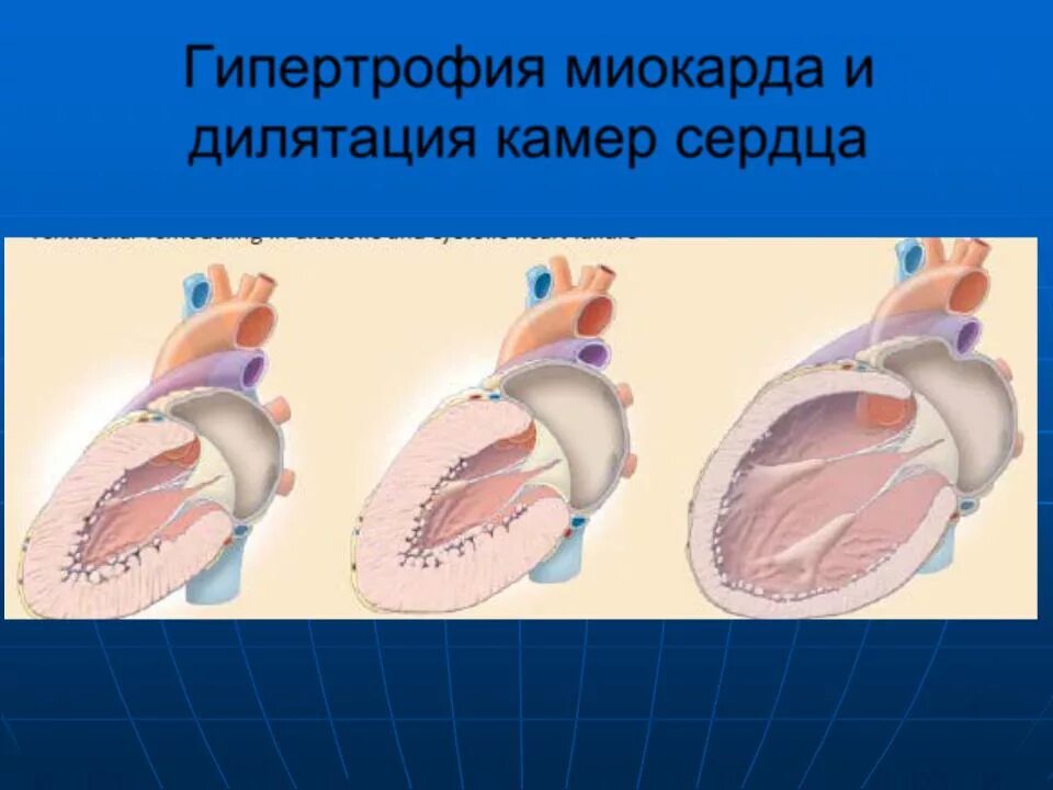 Гипертрофия полостей сердца. Гипертрофия камер сердца. дилятация и гипертрофия сердца. гипертрофия правых камер сердца.