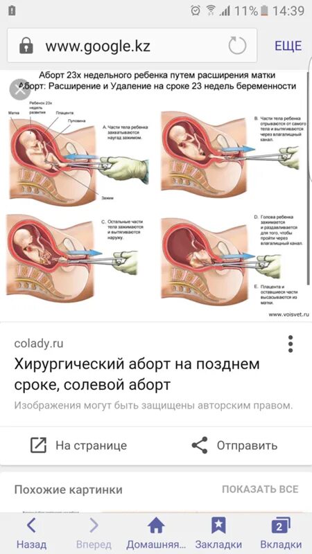 На каких сроках делается. После хирургического прерывания беременности. Прерывание беременности - аборт. Мини аборт хирургический.