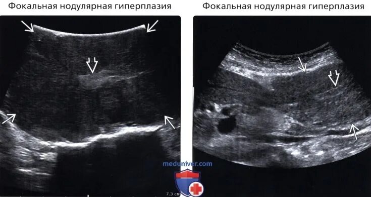 Фокальная нодулярная гиперплазия гистология. Фокальная нодулярная гиперплазия это. Очаговая нодулярная гиперплазия печени узи. Узловая гиперплазия печени кт. Гиперваскулярные образования печени на кт.