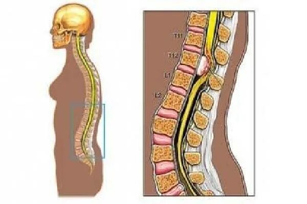 Позвоночник припухлость