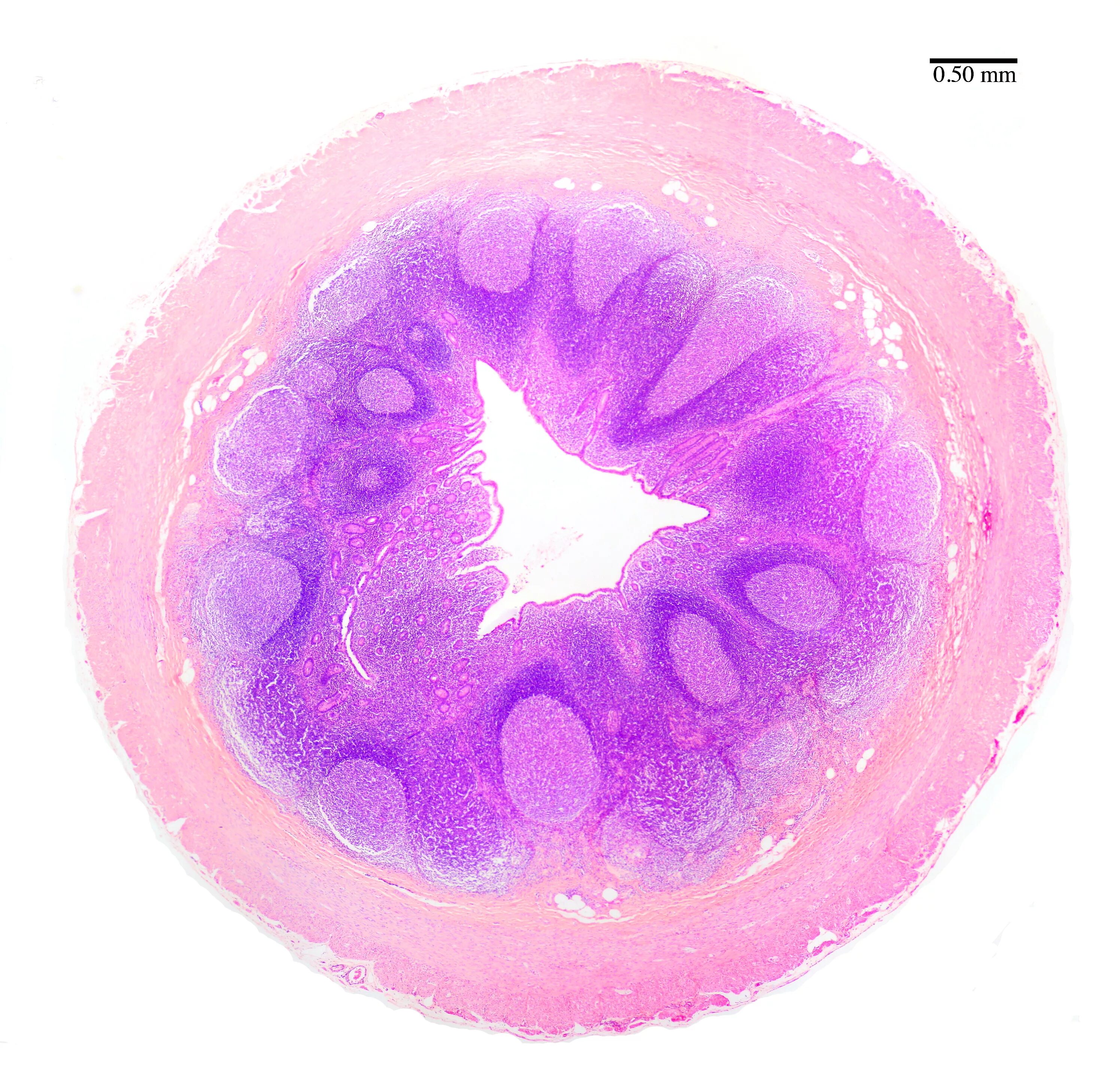 Стенка аппендикса гистология. Червеобразный отросток гистология препарат. Острый флегмонозный аппендицит гистология. Червеобразный отросток гистология. Аппендикс гистология препарат.