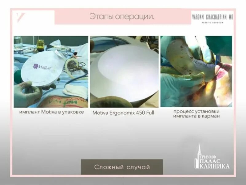 Импланты motiva ergonomix. Имплант мотива 400. Грудные импланты мотива. Грудные импланты motiva. Мотива круглые импланты.