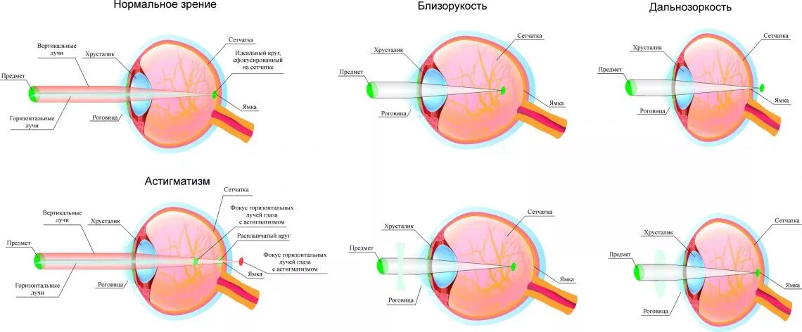 Аномалии рефракции глаза близорукость дальнозоркость астигматизм. Рефракция эмметропия. Аномалии рефракции миопия гиперметропия астигматизм. Гиперметропия сложной степени астигматизм.